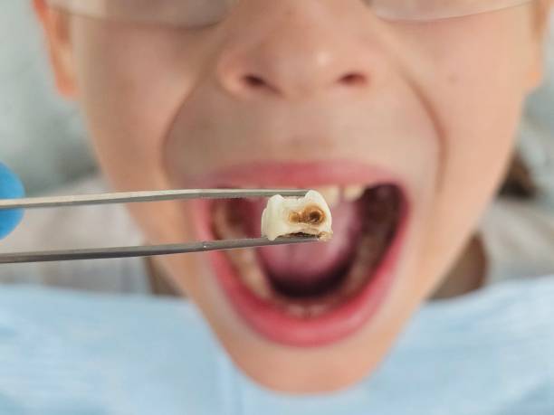 Best Emergency Treatment for Toothache in Kingstown, MD